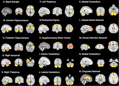 Structural Covariance Network as an Endophenotype in Alzheimer’s Disease-Susceptible Single-Nucleotide Polymorphisms and the Correlations With Cognitive Outcomes